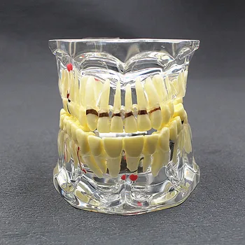 Модел патологични на зъбите с реставрационным мостовидным протеза Зъболекар за медицинската наука, на изучаването на стоматологични заболявания, изследване на зъбни импланти